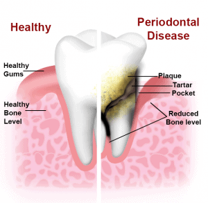 healthy-tooth